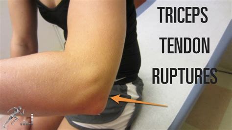 triceps tear test|partial tricep tendon tear treatment.